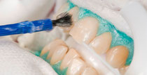 Auftragen des Bleaching-Gels (© Foto: Initiative pro Dente e.V.)