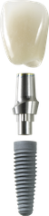 Implantat mit Aufbau und Krone (© proDente e.V.)